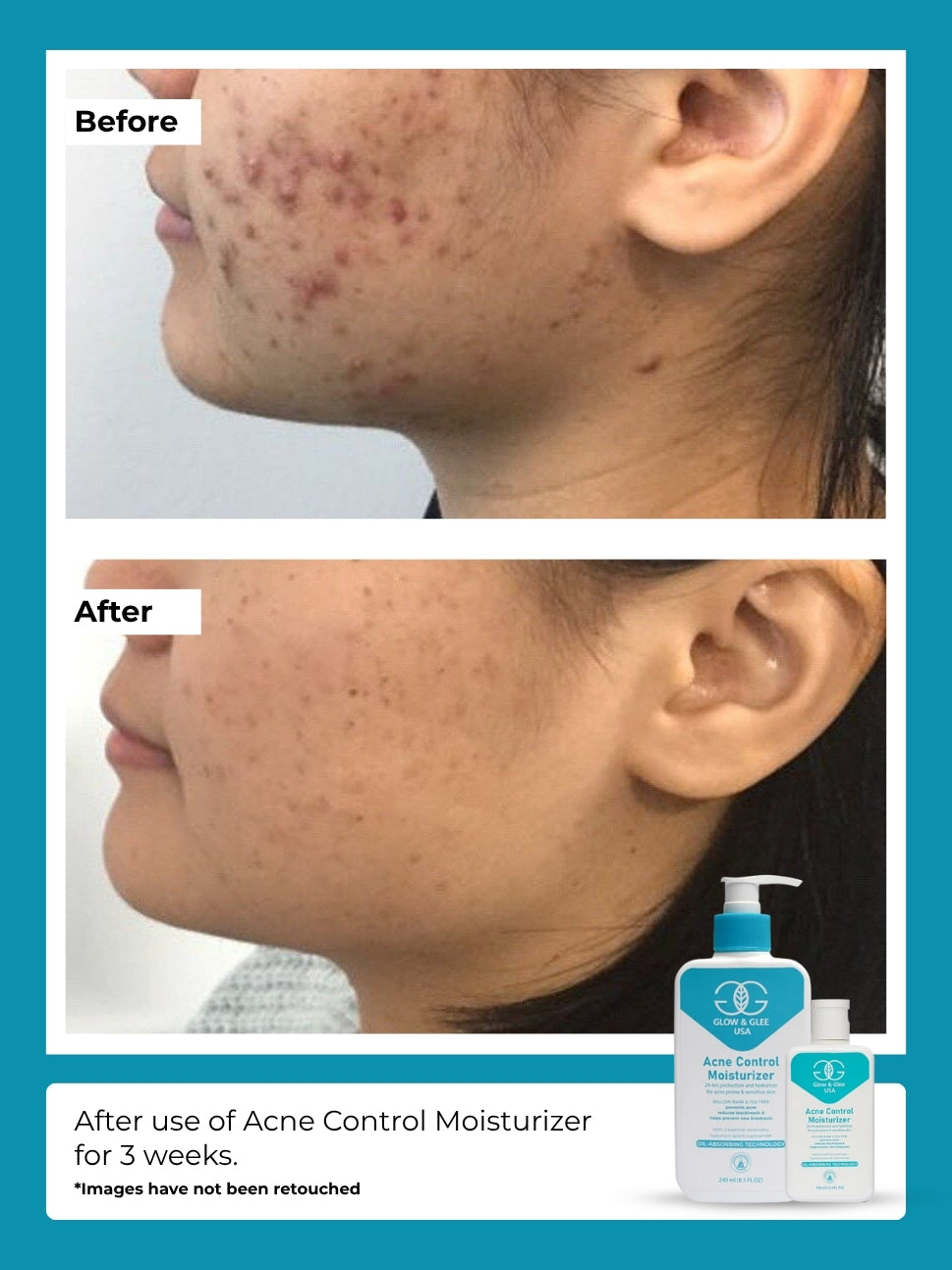 Acne  Control Moisturizer
