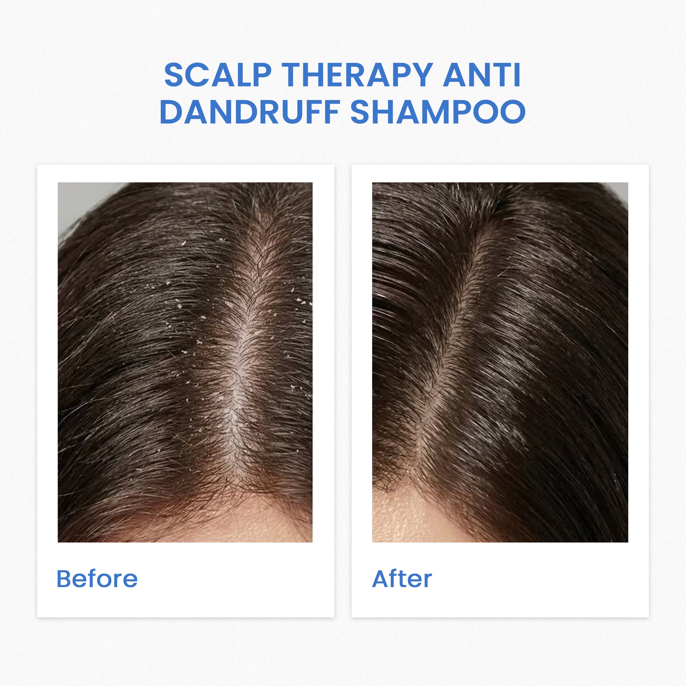 SCALP THERAPY ANTI-DANDRUFF SHAMPOO (240ML)
