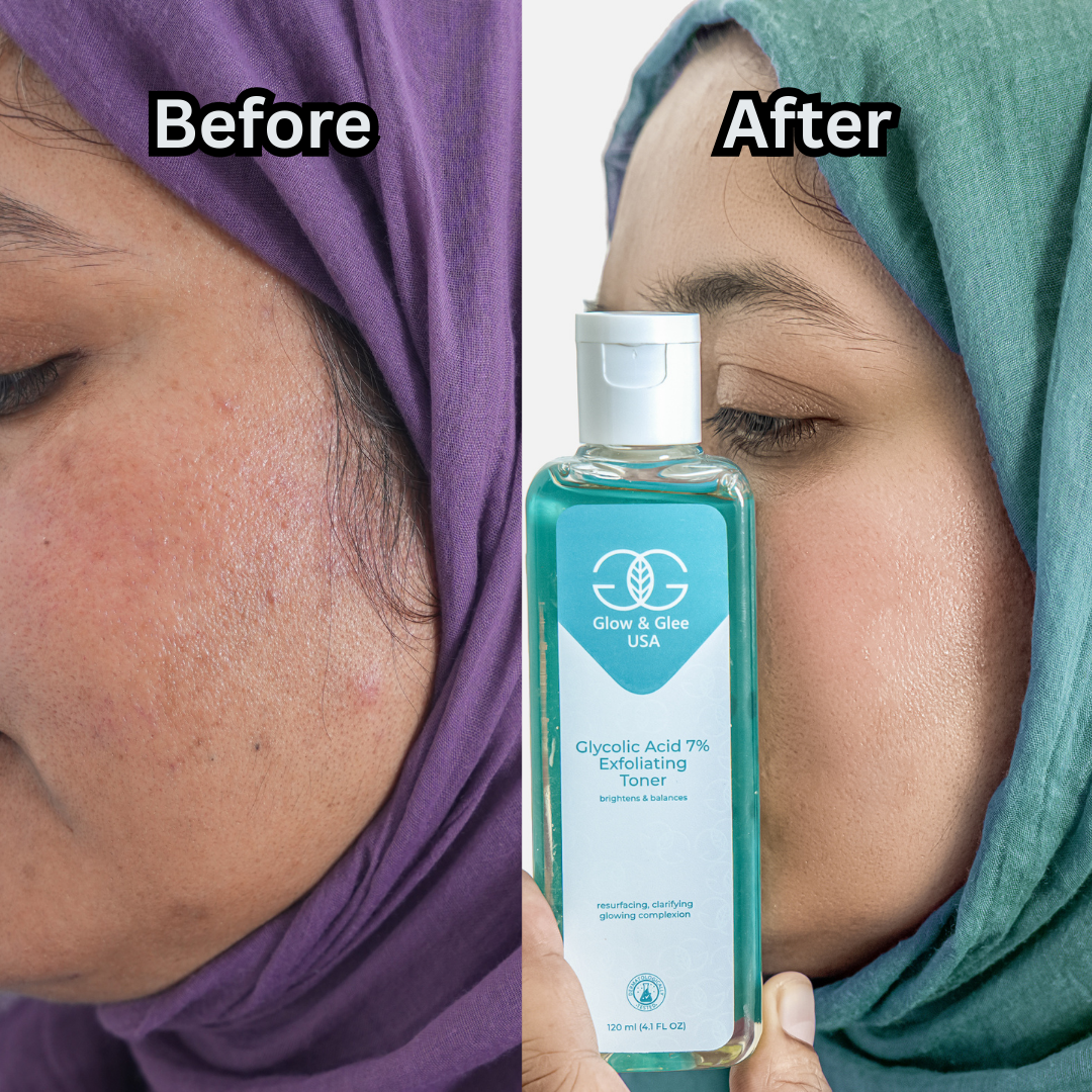 Glycolic Acid 7% Exfoliating Toner (120ML)