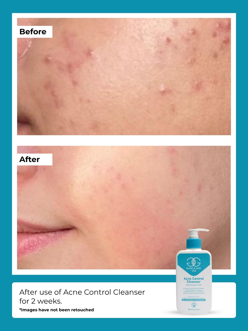 Acne Control Cleanser