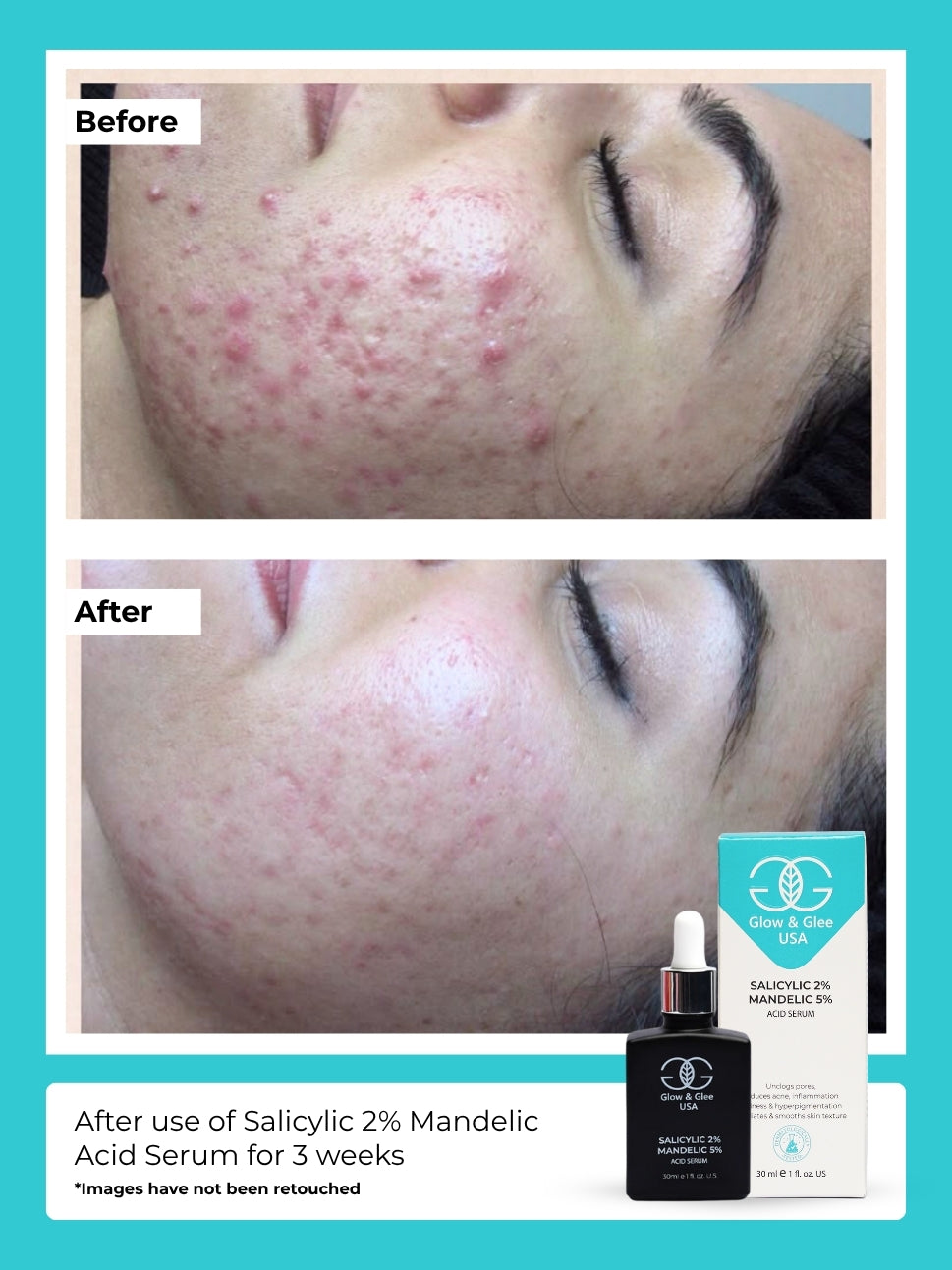 Salicylic 2% Mandelic Acid Serum 30Ml