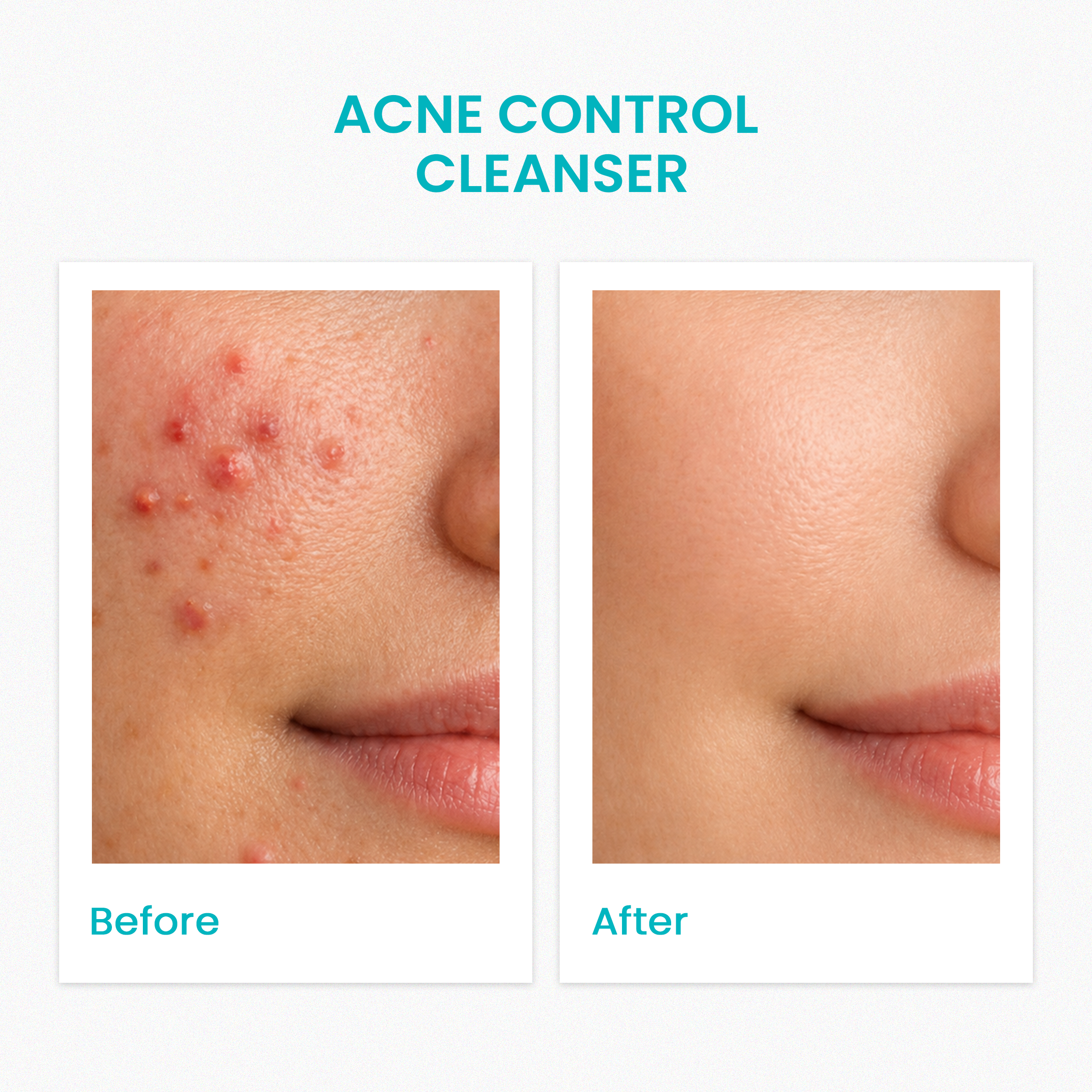 Acne Control Cleanser