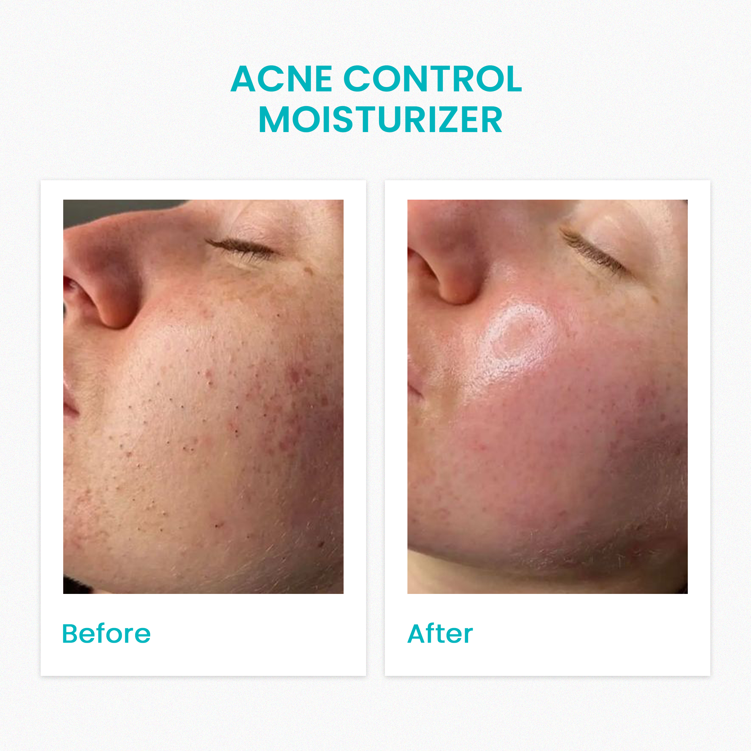 Acne  Control Moisturizer