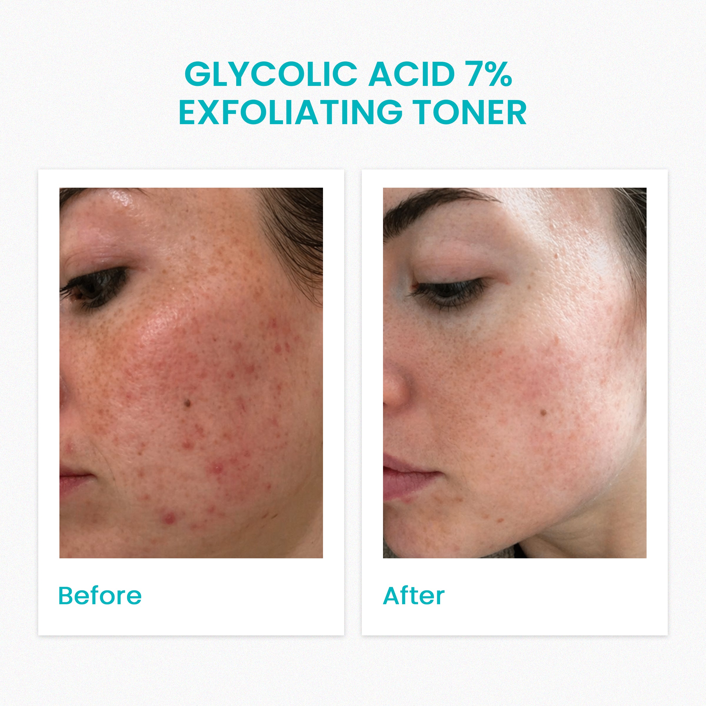 Glycolic Acid 7% Exfoliating Toner (120ML)