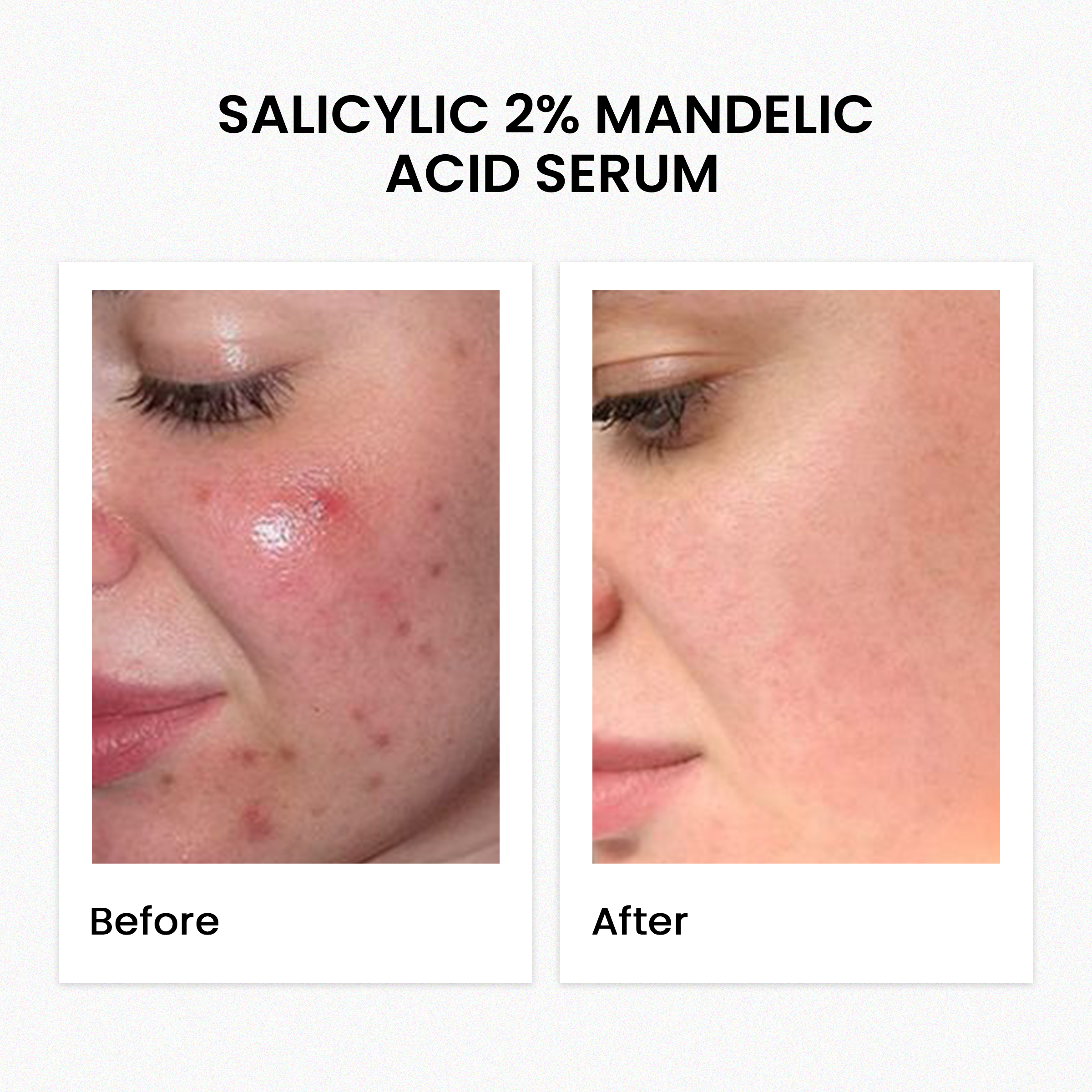 Salicylic 2% Mandelic Acid Serum 30Ml
